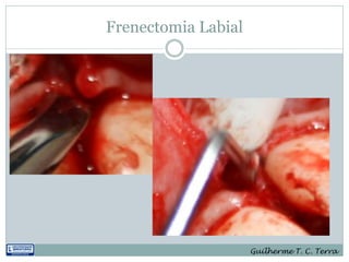 Frenectomia Labial




                     Guilherme T. C. Terra
 