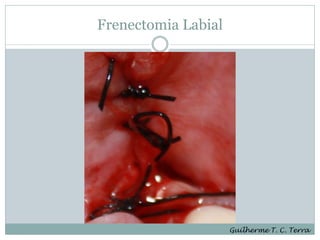 Frenectomia Labial




                     Guilherme T. C. Terra
 