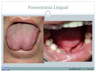 Frenectomia Lingual




                      Guilherme T. C. Terra
 