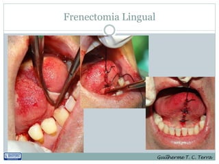 Frenectomia Lingual




                      Guilherme T. C. Terra
 