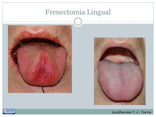 Frenectomia Lingual




                      Guilherme T. C. Terra
 