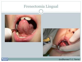 Frenectomia Lingual




                      Guilherme T. C. Terra
 