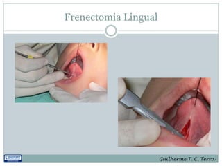Frenectomia Lingual




                      Guilherme T. C. Terra
 