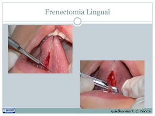 Frenectomia Lingual




                      Guilherme T. C. Terra
 