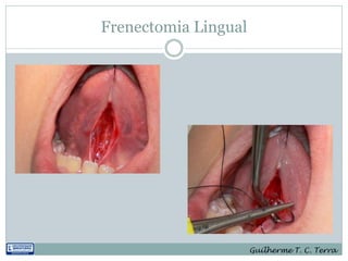 Frenectomia Lingual




                      Guilherme T. C. Terra
 