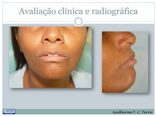 Avaliação clínica e radiográfica




                         Guilherme T. C. Terra
 