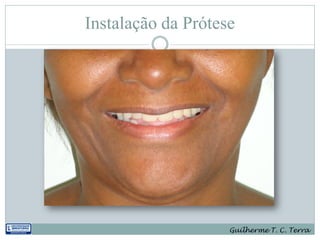 Instalação da Prótese




                    Guilherme T. C. Terra
 