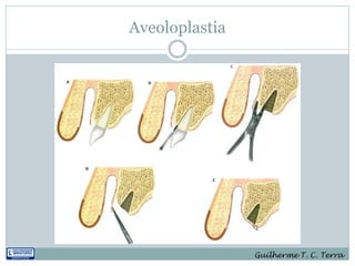 Aveoloplastia




                Guilherme T. C. Terra
 