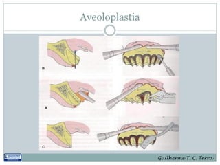 Aveoloplastia




                Guilherme T. C. Terra
 
