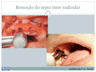 Remoção do septo inter radicular




                          Guilherme T. C. Terra
 