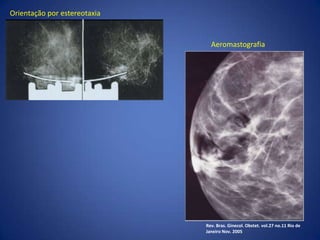 Cirurgia radioguiada no câncer de mama