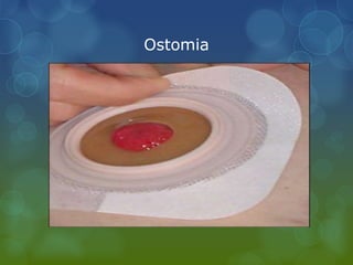 Ostomia
 