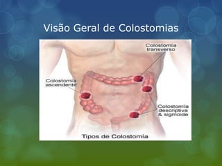 Visão Geral de Colostomias
 