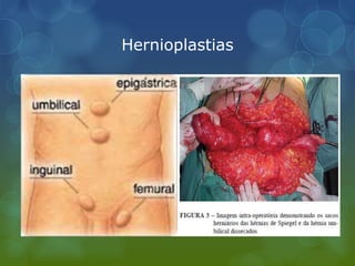 Hernioplastias
 