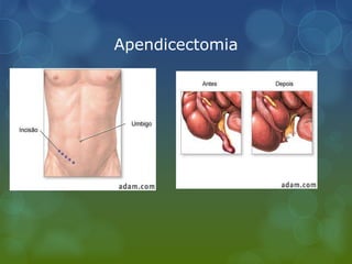 Apendicectomia
 
