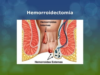 Hemorroidectomia
 