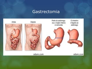 Gastrectomia
 
