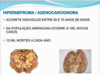 HIPERNEFROMA / ADENOCARCIONOMA
ACOMETE INDIVIDUOS ENTRE 50 E 70 ANOS DE IDADE.
NA POPULAÇÃO AMERICANA OCORRE 51 MIL NOVOS
CASOS.
13 MIL MORTES A CADA ANO.
 