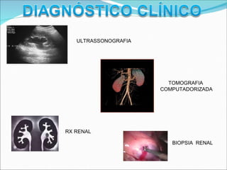 ULTRASSONOGRAFIA
TOMOGRAFIA
COMPUTADORIZADA
RX RENAL
BIOPSIA RENAL
 