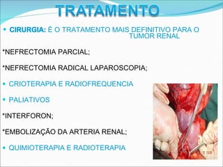 CIRURGIA: É O TRATAMENTO MAIS DEFINITIVO PARA O
TUMOR RENAL
*NEFRECTOMIA PARCIAL;
*NEFRECTOMIA RADICAL LAPAROSCOPIA;
CRIOTERAPIA E RADIOFREQUENCIA
PALIATIVOS
*INTERFORON;
*EMBOLIZAÇÃO DA ARTERIA RENAL;
QUIMIOTERAPIA E RADIOTERAPIA
 