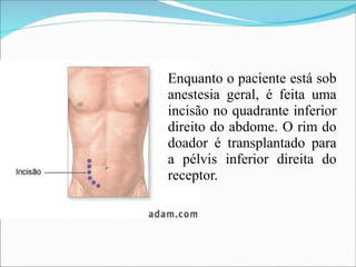 Enquanto o paciente está sob
anestesia geral, é feita uma
incisão no quadrante inferior
direito do abdome. O rim do
doador é transplantado para
a pélvis inferior direita do
receptor.
 