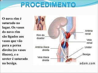 O novo rim é
suturado no
lugar. Os vasos
do novo rim
são ligados aos
vasos que vão
para a perna
direita (os vasos
ilíacos), e o
ureter é suturado
na bexiga.
 