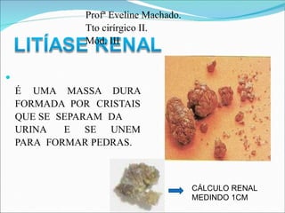 ●
É UMA MASSA DURA
FORMADA POR CRISTAIS
QUE SE SEPARAM DA
URINA E SE UNEM
PARA FORMAR PEDRAS.
CÁLCULO RENAL
MEDINDO 1CM
Profª Eveline Machado.
Tto cirírgico II.
Mód. III
 