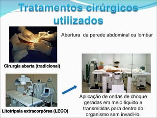 Abertura da parede abdominal ou lombar
Cirurgia aberta (tradicional)
Aplicação de ondas de choque
geradas em meio líquido e
transmitidas para dentro do
Litotripsia extracorpórea (LECO)
organismo sem invadi-lo.
 