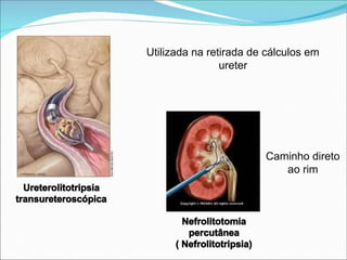 Utilizada na retirada de cálculos em
ureter
Caminho direto
ao rim
Ureterolitotripsia
transureteroscópica
Nefrolitotomia
percutânea
( Nefrolitotripsia)
 