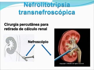 Cirurgia percutânea para
retirada de cálculo renal
Nefroscópio
 