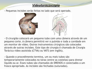 Videotoracoscopia
- Pequenas incisões serão feitas no lado que será operado.




- O cirurgião colocará um pequeno tubo com uma câmera através de um
pequeno corte. A câmera permitirá ver o pulmão e toda a cavidade em
um monitor de vídeo. Outros instrumentos cirúrgicos são colocados
através de outras incisões. Este tipo de cirurgia é chamada de Cirurgia
Torácica vídeo assistida (CTVA) ou VATS (em inglês).

- Quando o procedimento termina, um ou mais tubos são
temporariamente colocados no tórax (entre as costelas) para drenar
líquido ou ar. Esses tubos são chamados de DRENOS e conectados a um
frasco apropriado. As incisões são fechadas (suturadas).
 
