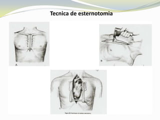 Tecnica de esternotomia
 