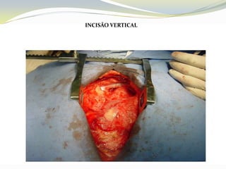 INCISÃO VERTICAL
 