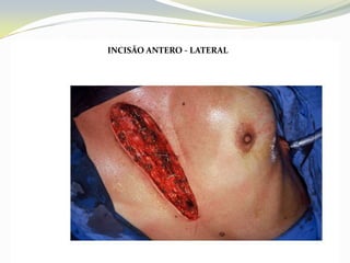 INCISÃO ANTERO - LATERAL
 