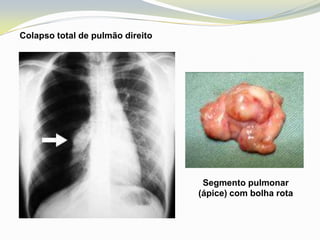 Colapso total de pulmão direito




                                   Segmento pulmonar
                                  (ápice) com bolha rota
 