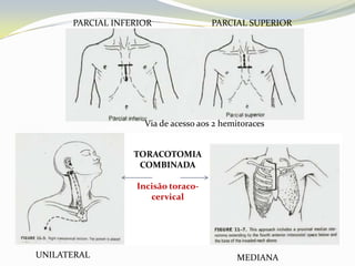 PARCIAL INFERIOR               PARCIAL SUPERIOR




                    Via de acesso aos 2 hemitoraces


                  TORACOTOMIA
                   COMBINADA

                  Incisão toraco-
                     cervical




UNILATERAL                                 MEDIANA
 