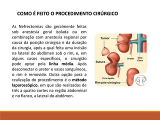As Nefrectomias são geralmente feitas
sob anestesia geral isolada ou em
combinação com anestesia regional por
causa da posição cirúrgica e da duração
da cirurgia, após a qual feita uma incisão
na lateral do abdômen sob o rim, e, em
alguns casos específicos, o cirurgião
pode optar pela linha média. Após
desconectar o ureter e vasos sanguíneos,
o rim é removido. Outra opção para a
realização do procedimento é o método
laparoscópico, em que são realizados de
três a quatro cortes na região abdominal
e no flanco, a lateral do abdômen.
COMO É FEITO O PROCEDIMENTO CIRÚRGICO
 