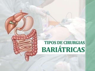 TIPOS DE CIRURGIAS
BARIÁTRICAS
 