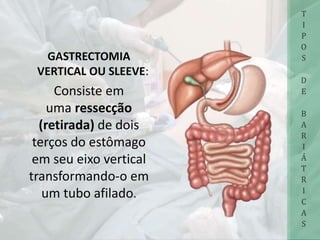 GASTRECTOMIA
VERTICAL OU SLEEVE:
Consiste em
uma ressecção
(retirada) de dois
terços do estômago
em seu eixo vertical
transformando-o em
um tubo afilado.
T
I
P
O
S
D
E
B
A
R
I
Á
T
R
I
C
A
S
 