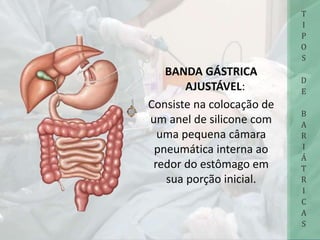 BANDA GÁSTRICA
AJUSTÁVEL:
Consiste na colocação de
um anel de silicone com
uma pequena câmara
pneumática interna ao
redor do estômago em
sua porção inicial.
T
I
P
O
S
D
E
B
A
R
I
Á
T
R
I
C
A
S
 