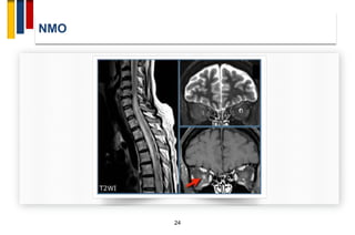 clinically isolated syndromes | PDF