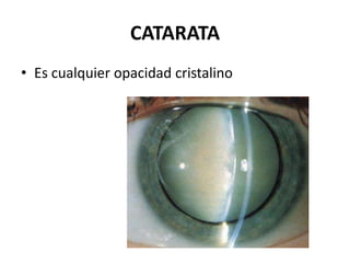 CATARATA
• Es cualquier opacidad cristalino
 
