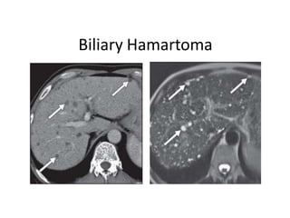 Biliary Hamartoma
 