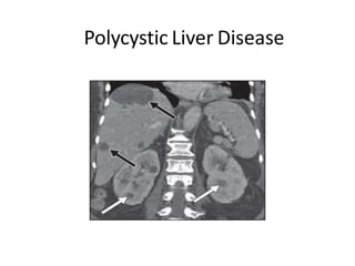 Polycystic Liver Disease
 