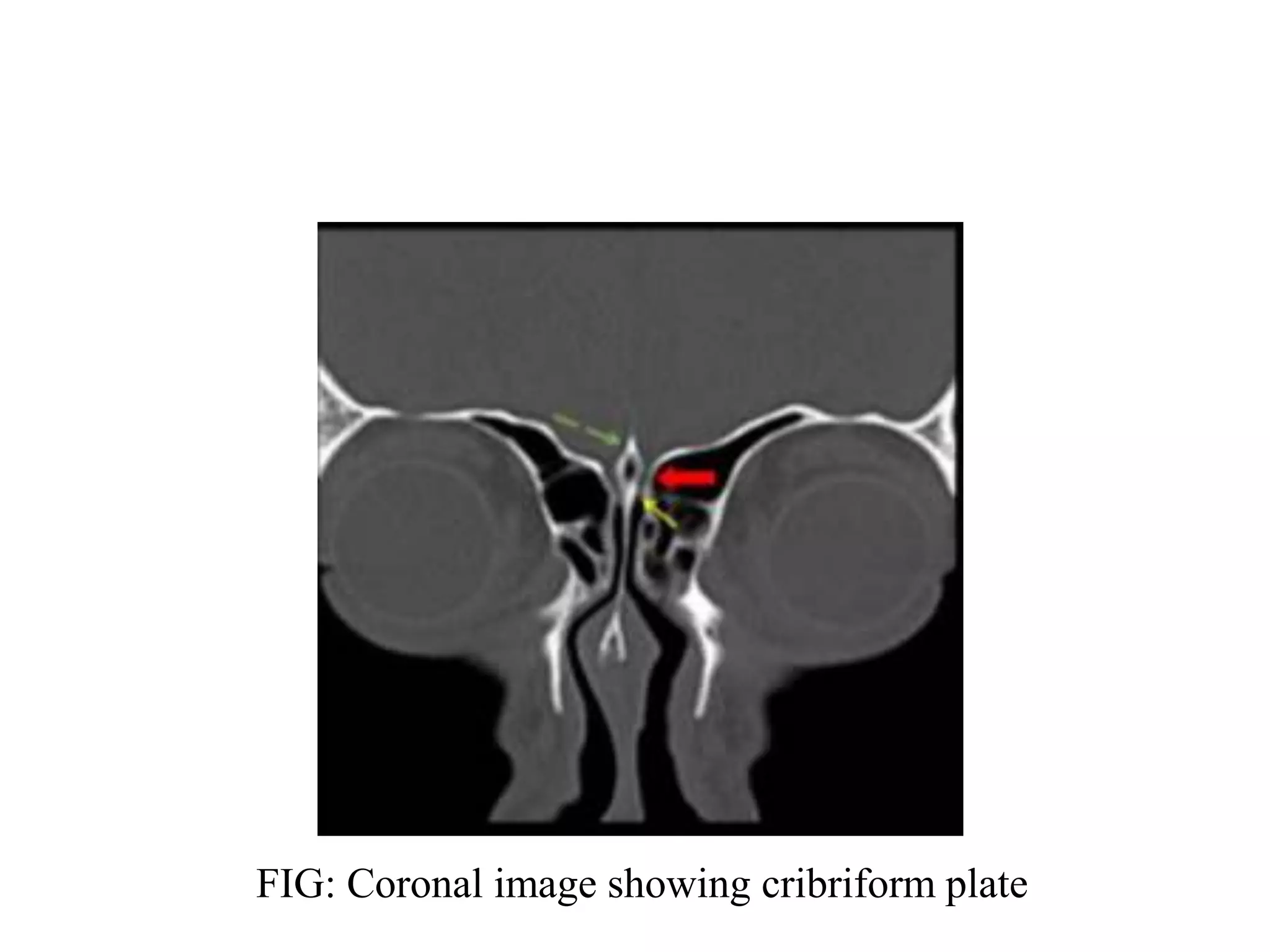 FIG: Coronal image showing cribriform plate
 