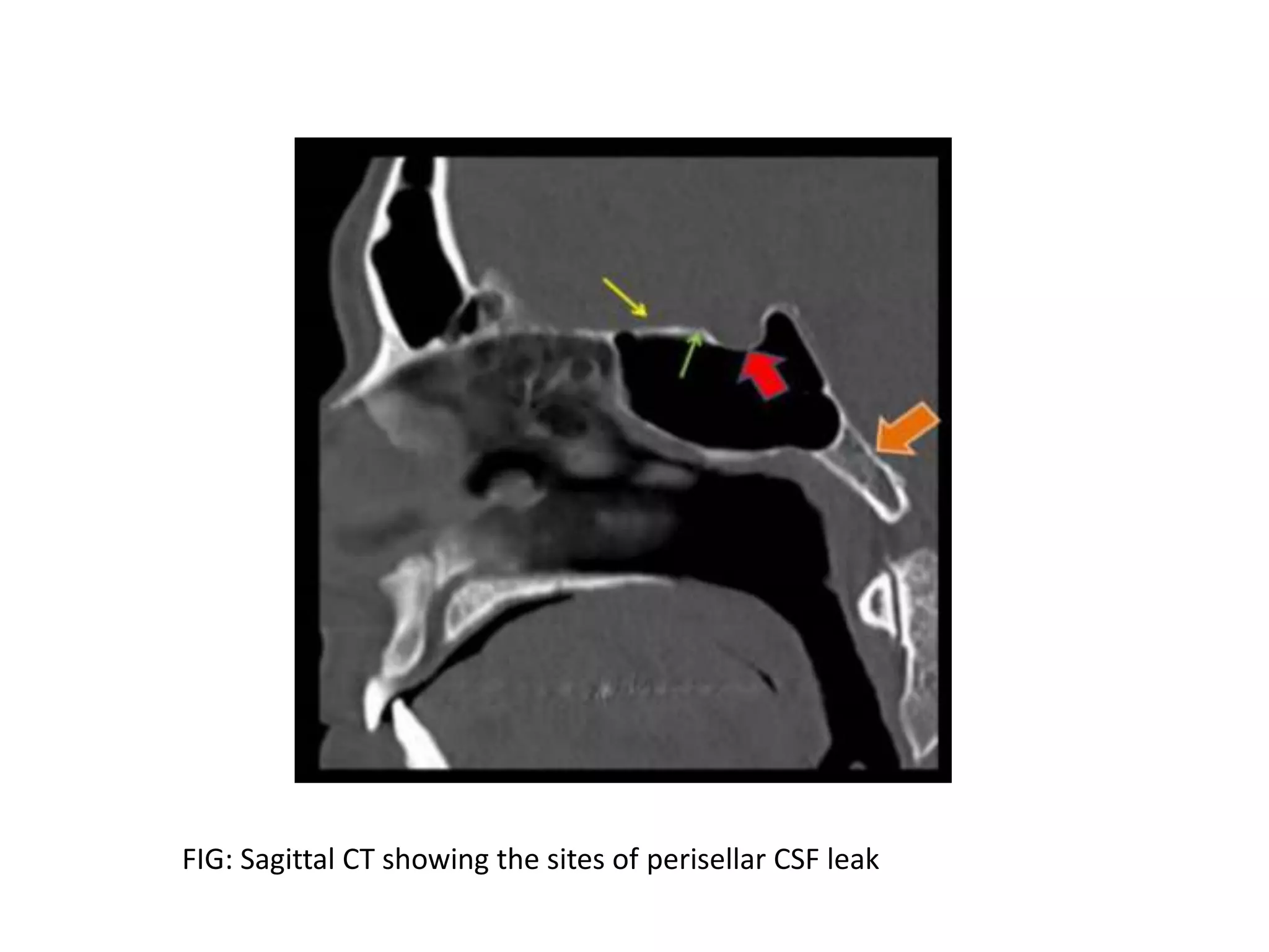 FIG: Sagittal CT showing the sites of perisellar CSF leak
 