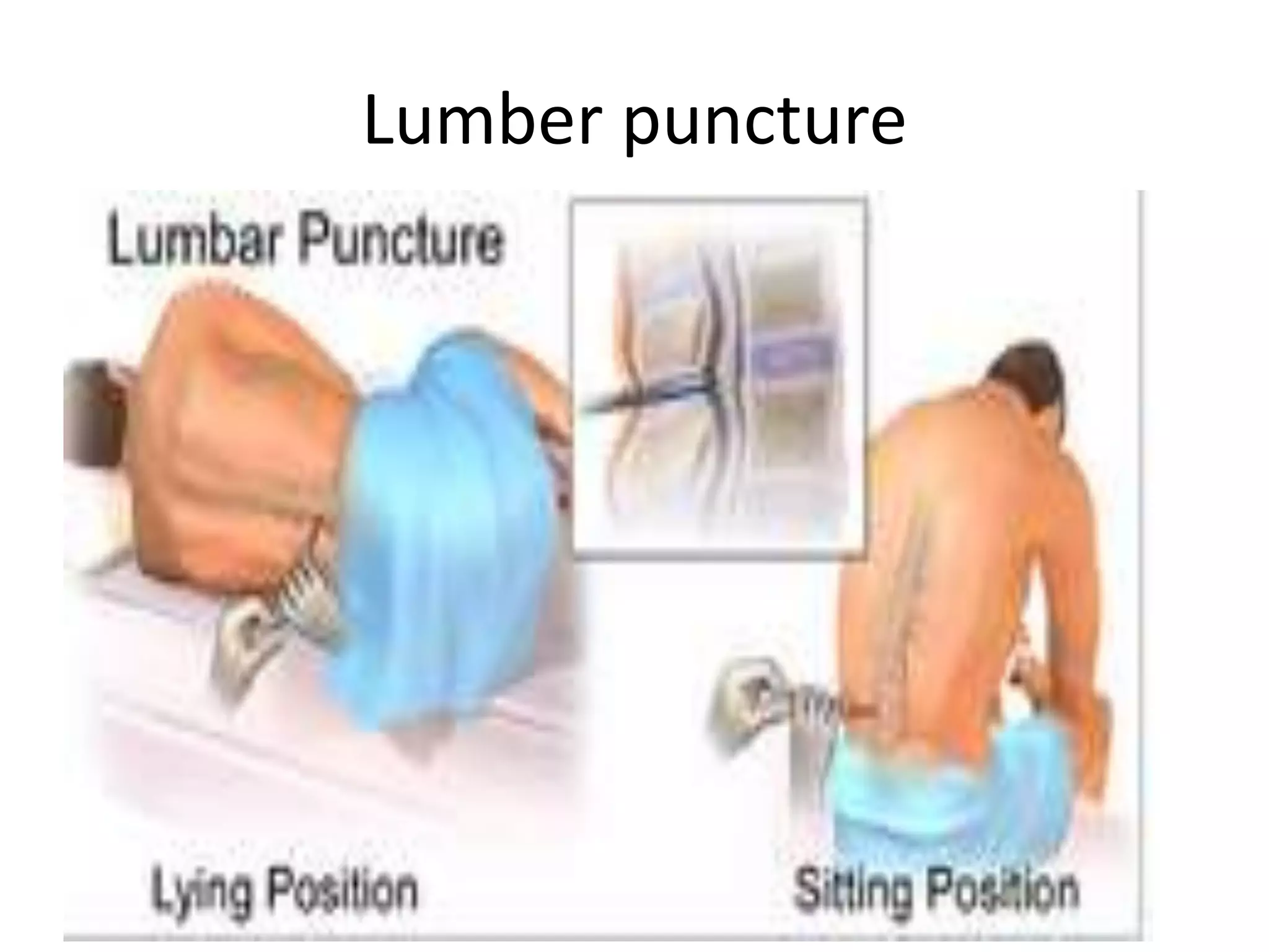 Lumber puncture
 