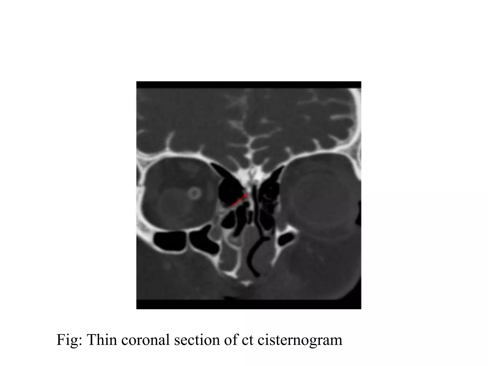 Fig: Thin coronal section of ct cisternogram
 