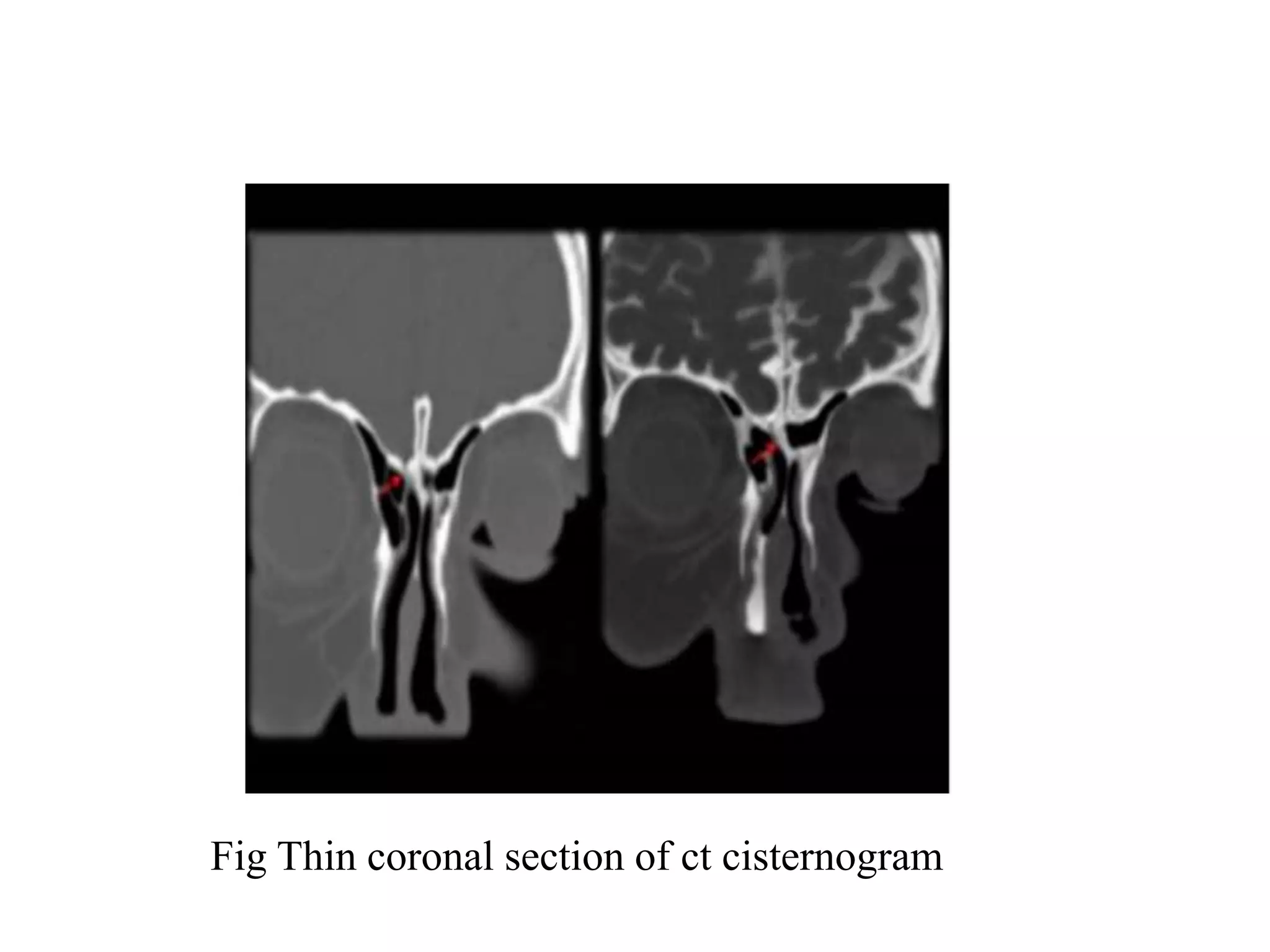 Fig Thin coronal section of ct cisternogram
 