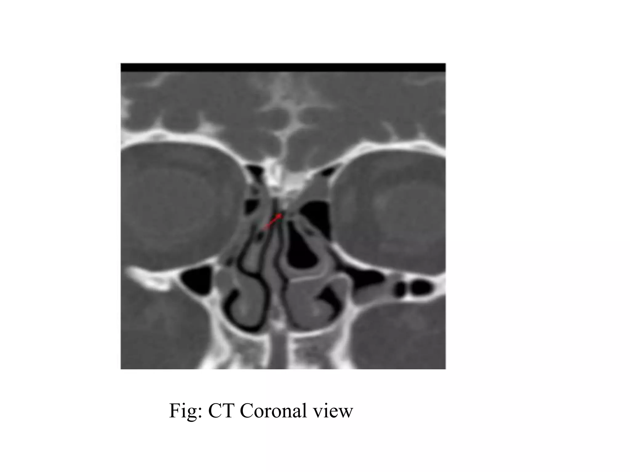 Fig: CT Coronal view
 